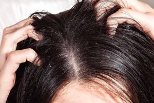le cause e i rimedi del cuoio capelluto secco